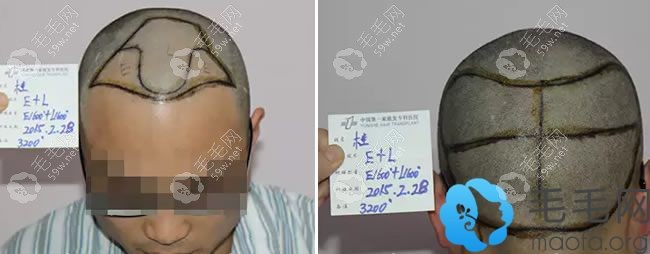 桂先生在雍禾的植发设计方案图