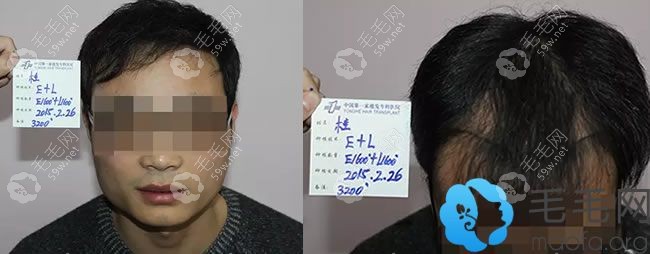 桂先生植发前正面照和头顶照
