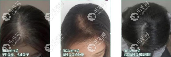 北京美莱生发小魔瓶生发效果