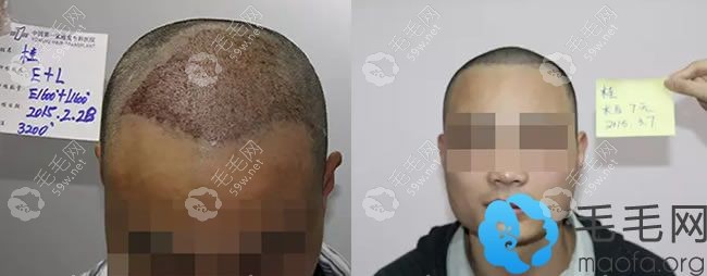 雍禾为桂先生植发术后七天效果图