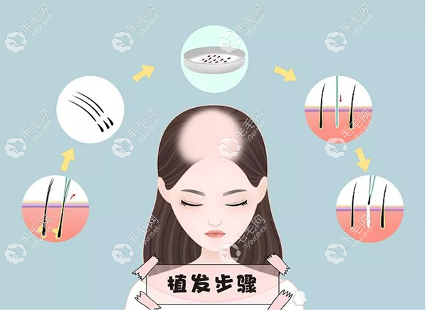 福州专门植发的医院技术比较好
