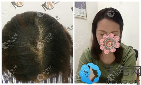 哈尔滨成美头顶加密种植案例
