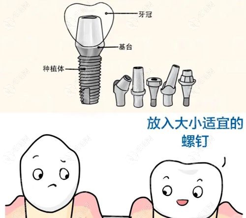 广州性价比高的种植牙医院推荐:这5家种牙费用透明好又便宜