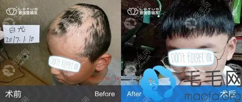 碧莲盛bht疤痕植发案例效果