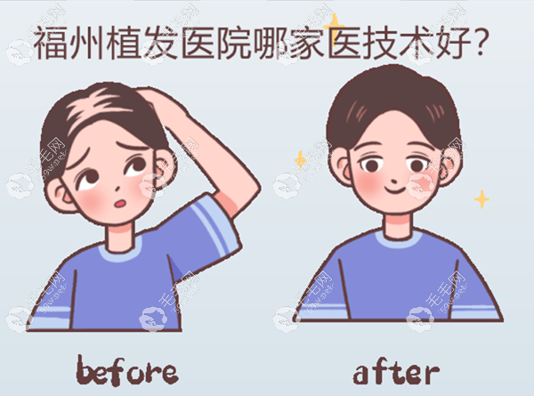 福州植发医院哪家医技术好