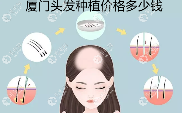 厦门头发种植价格多少钱左右 59w.net