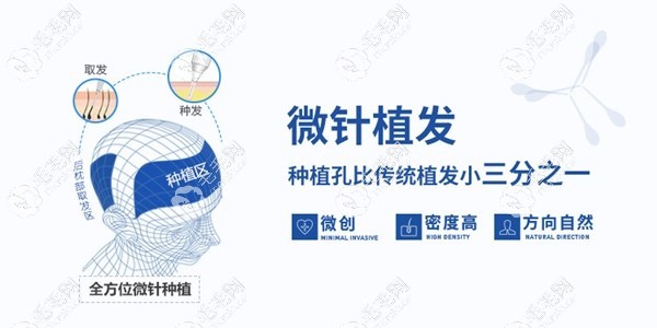 杭州大麦微针植发技术优势
