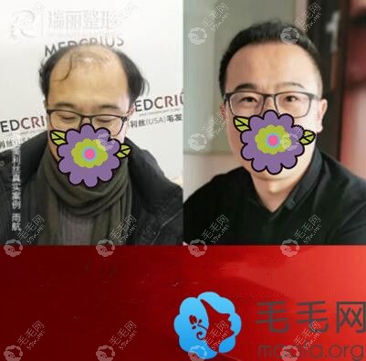 黑龙江瑞丽植发案例
