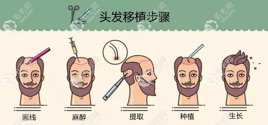 植发是怎样在视觉上增加发量的