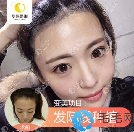 州华领女士发际线植发前后对比照片