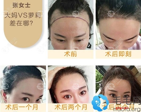 郑州集美发际线种植案例效果图