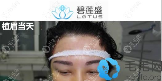 植眉當(dāng)天眉毛上有隱隱約約的血痂