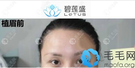 種植眉毛前的照片