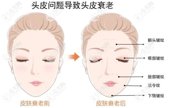 深圳鵬程植發(fā)說頭皮衰老問題會(huì)導(dǎo)致臉部皮膚的衰老，額角皺紋，眼部皺紋