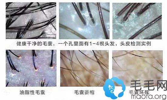 通過毛囊檢測結(jié)果來獲知毛囊健康情況