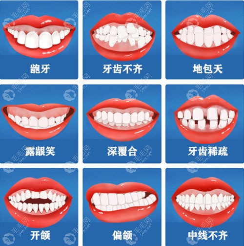 2025儿童牙齿矫正隐形牙套价格