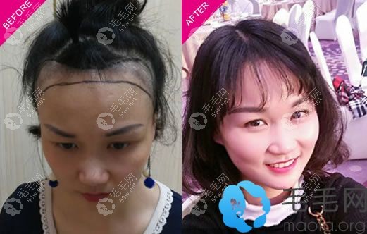 佛山华美植发发际线种植案例