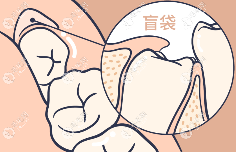 医生为什么建议四颗智齿都拔