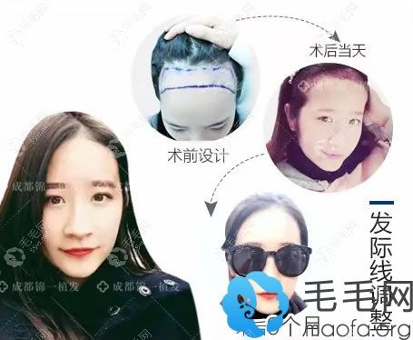 腾女士在成都锦一植发9个月效果