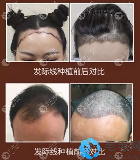 佛山华美胡译园种植发际线案例