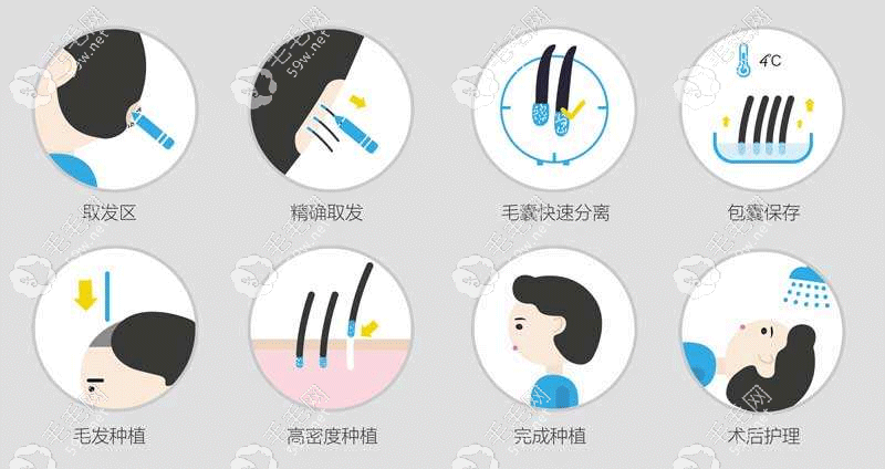內(nèi)分泌失調(diào)脫發(fā)通過植發(fā)手術(shù)調(diào)理長(zhǎng)出新發(fā)