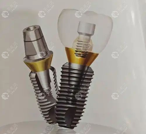 意大利西傲种植牙什么价位?种一颗牙4800元起,EV/MINI/CLC全解析