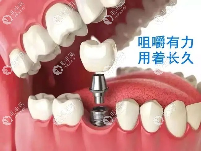 种植牙结构示意图