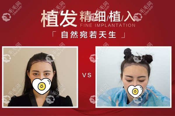 昆明藝星AHT藝術種植發(fā)際線案例效果
