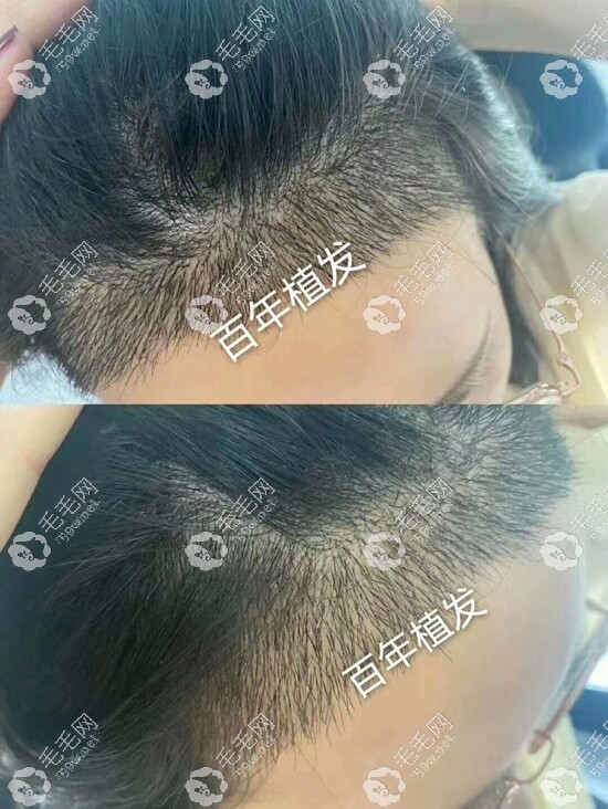 常州百年女士发际线种植效果