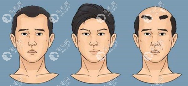植发后发生断层怎么办要补种吗