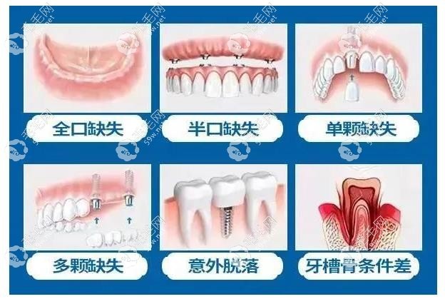 西安团圆口腔医院种植牙医生推荐