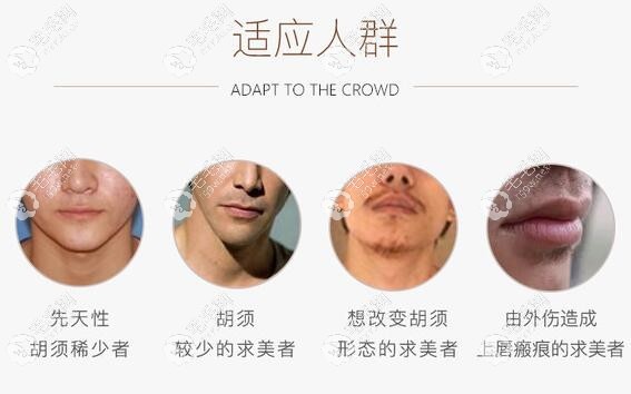 胡须种植适应人群