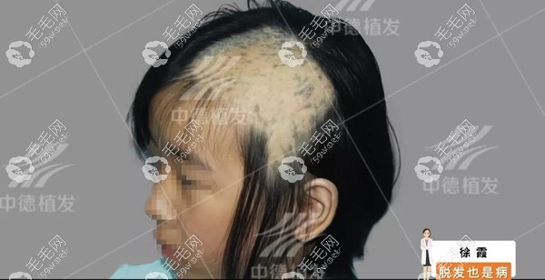 小孩子头皮烫伤能植发吗