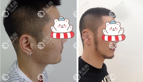 胡须种植<span style=