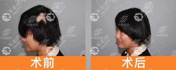 未成年疤痕植发效果图