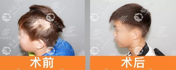 儿童疤痕植发案例效果