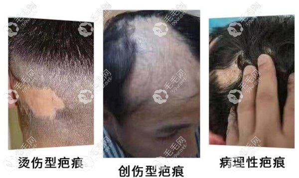 重庆疤痕植发<span style=