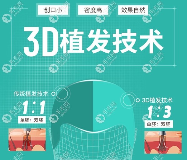 上海新生3D胡须种植技术