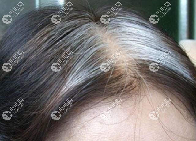 新長的白發(fā)是從發(fā)根開始的