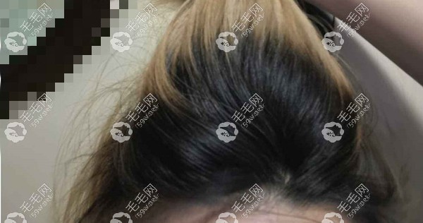 染發(fā)后數(shù)月后，發(fā)根和染發(fā)區(qū)顏色不同