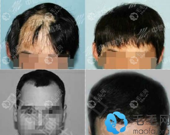 北京中德徐霞疤痕植發(fā)案例及發(fā)際線調(diào)整前后對比效果