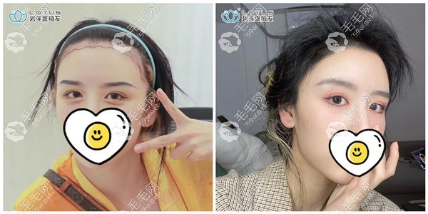 杭州碧莲盛植发医生张卓发际线种植效果