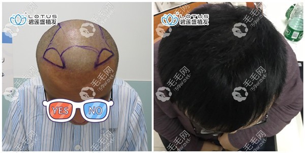 杭州碧莲盛杨昕头发加密案例效果