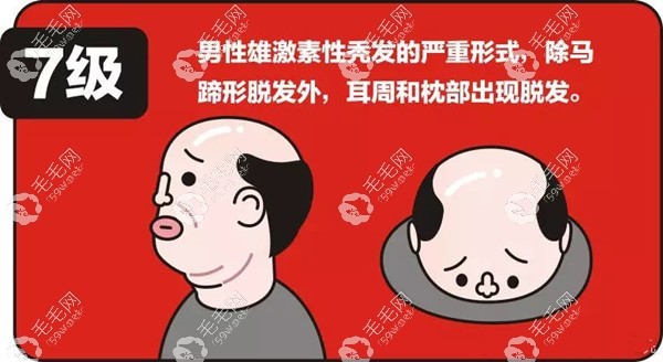 7级脱发的脱发面积在100-140平方厘米