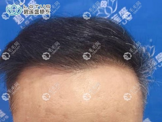 做頭發(fā)加密一年后效果圖