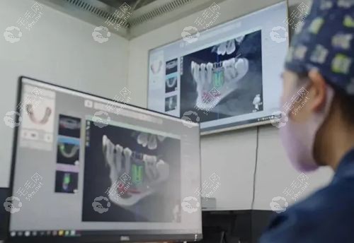 集采种植牙指导价单颗种植牙880元一颗