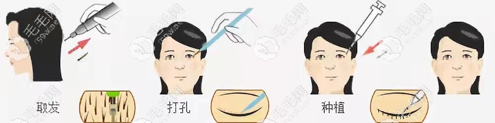 睫毛種植手術(shù)操作流程示意圖