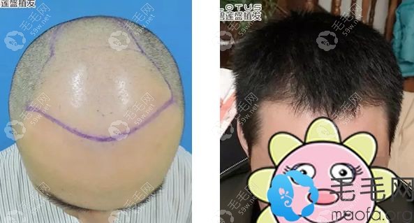 北京碧莲盛植发失败修复效果怎么样
