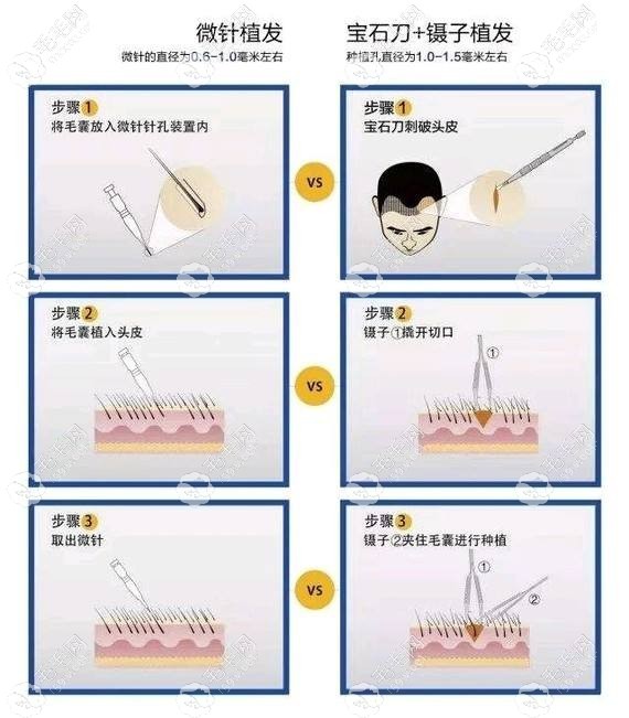微针技术和宝石刀技术操作对比示意图