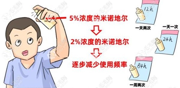 改善米诺地尔停药复脱的方法.jpg